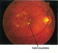 Download 770 Background Retinopathy Paling Keren