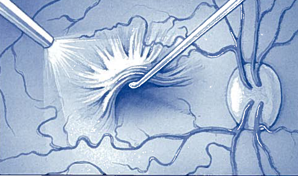 Macular pucker retina specialists eye surgery retina associates
